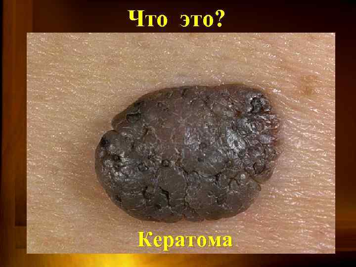 Что это? Кератома 