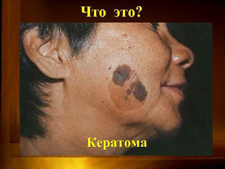 Что это? Кератома 