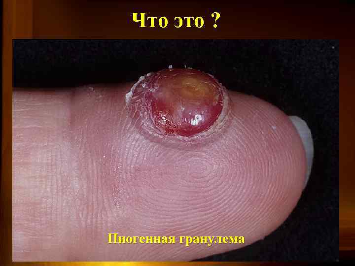 Что это ? Пиогенная гранулема 