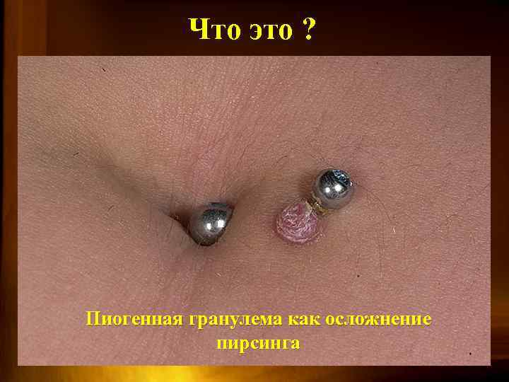 Что это ? Пиогенная гранулема как осложнение пирсинга 