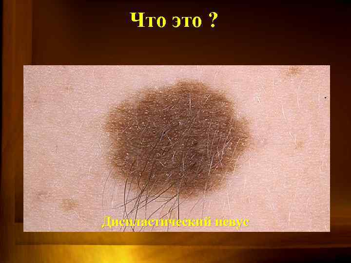 Что это ? Диспластический невус 
