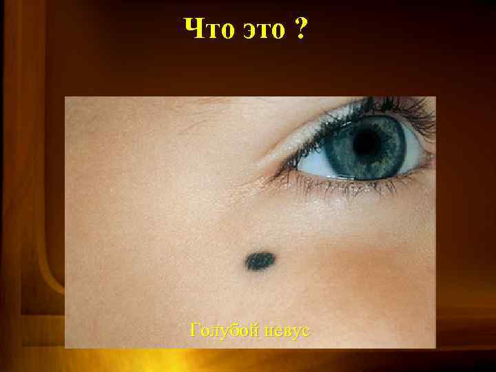 Что это ? Голубой невус 