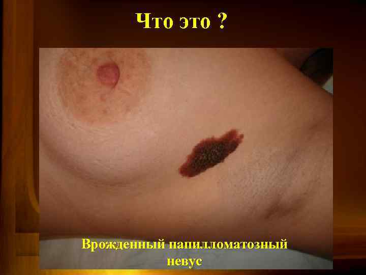 Что это ? Врожденный папилломатозный невус 