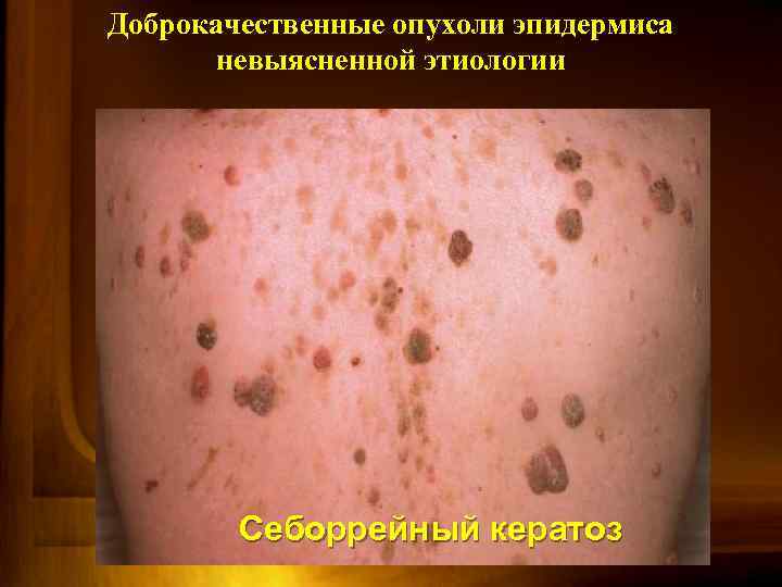 Доброкачественные опухоли эпидермиса невыясненной этиологии Себоррейный кератоз 