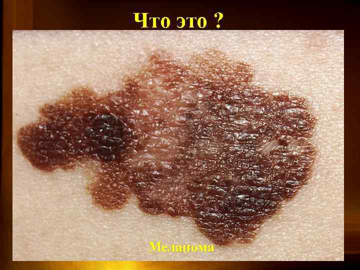 Что это ? Меланома 