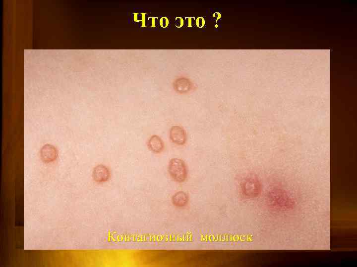 Что это ? Контагиозный моллюск 