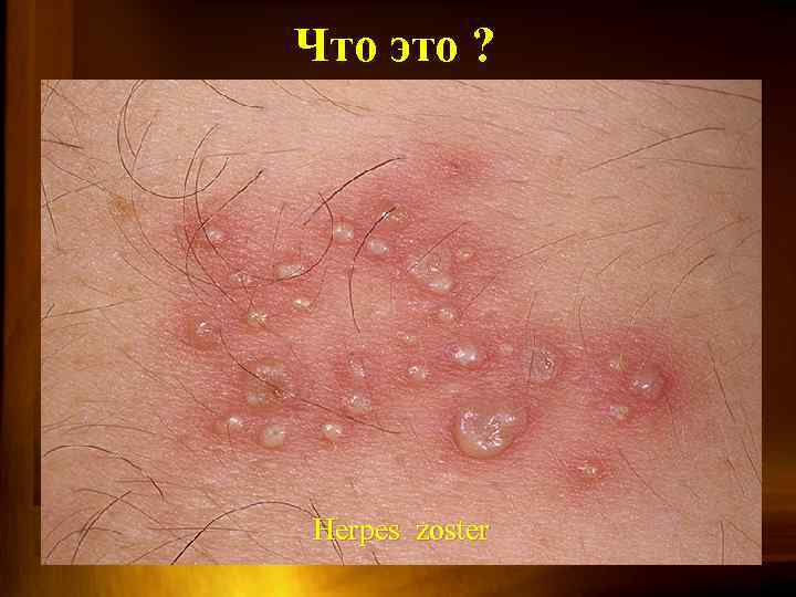 Что это ? Herpes zoster 