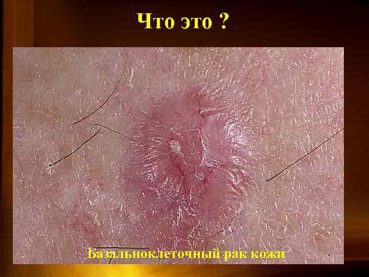 Что это ? Базальноклеточный рак кожи 