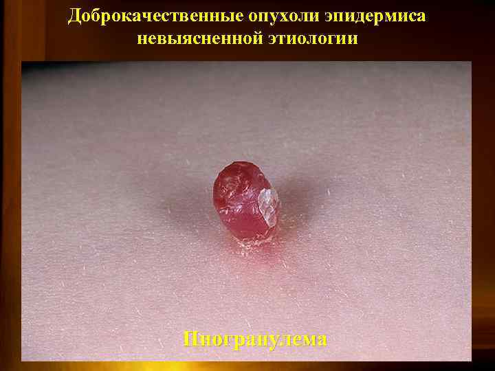 Доброкачественные опухоли эпидермиса невыясненной этиологии Пиогранулема 