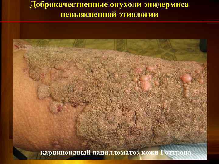 Доброкачественные опухоли эпидермиса невыясненной этиологии карциноидный папилломатоз кожи Готтрона 