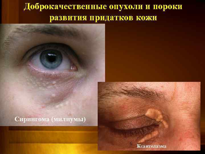 Доброкачественные опухоли и пороки развития придатков кожи Сирингома (милиумы) Ксантелазма 