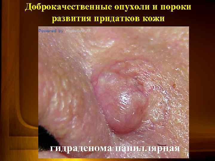 Доброкачественные опухоли и пороки развития придатков кожи гидраденома папиллярная 