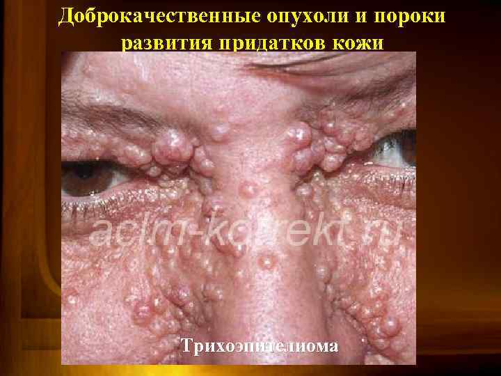 Доброкачественные опухоли и пороки развития придатков кожи Трихоэпителиома эккринная порома 
