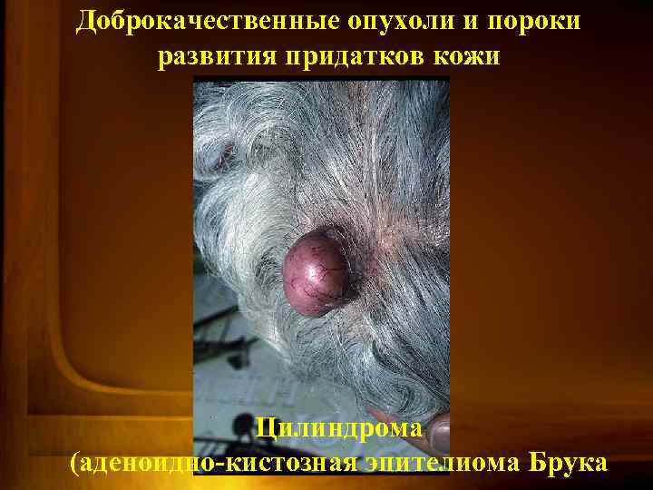 Доброкачественные опухоли и пороки развития придатков кожи Цилиндрома (аденоидно-кистозная эпителиома Брука 