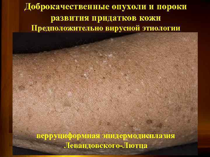 Доброкачественные опухоли и пороки развития придатков кожи Предположительно вирусной этиологии верруциформная эпидермодисплазия Левандовского-Лютца 