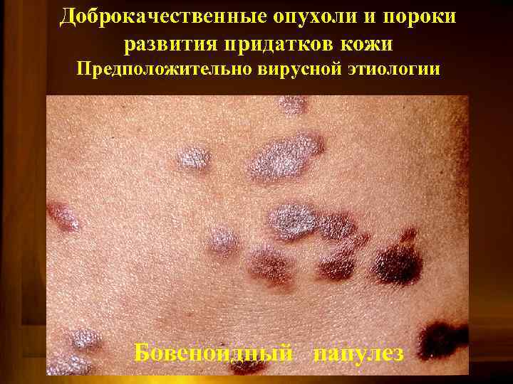 Доброкачественные опухоли и пороки развития придатков кожи Предположительно вирусной этиологии Бовеноидный папулез 