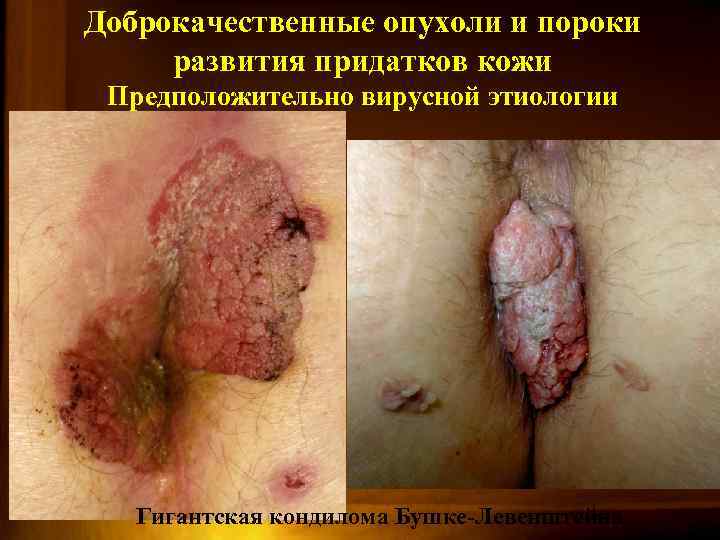 Доброкачественные опухоли и пороки развития придатков кожи Предположительно вирусной этиологии Гигантская кондилома Бушке-Левенштейна 