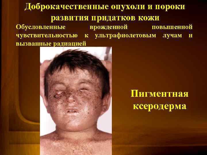 Доброкачественные опухоли и пороки развития придатков кожи Обусловленные врожденной повышенной чувствительностью к ультрафиолетовым лучам