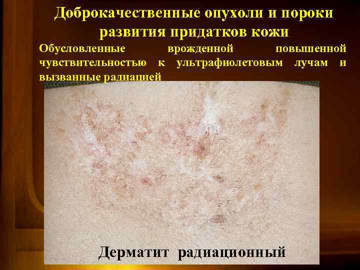 Доброкачественные опухоли и пороки развития придатков кожи Обусловленные врожденной повышенной чувствительностью к ультрафиолетовым лучам