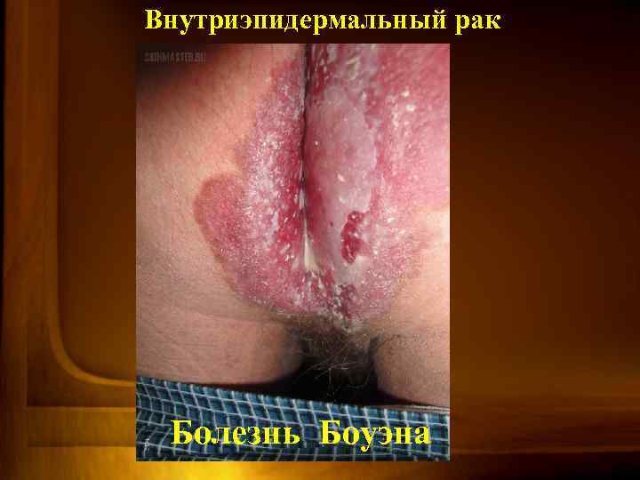 Внутриэпидермальный рак Болезнь Боуэна 