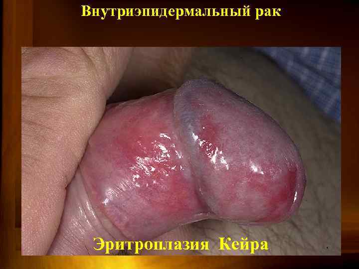 Внутриэпидермальный рак Эритроплазия Кейра 