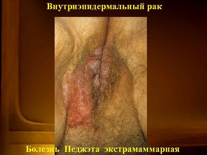 Внутриэпидермальный рак Болезнь Педжэта экстрамаммарная 