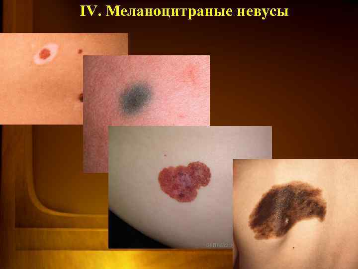  IV. Меланоцитраные невусы 