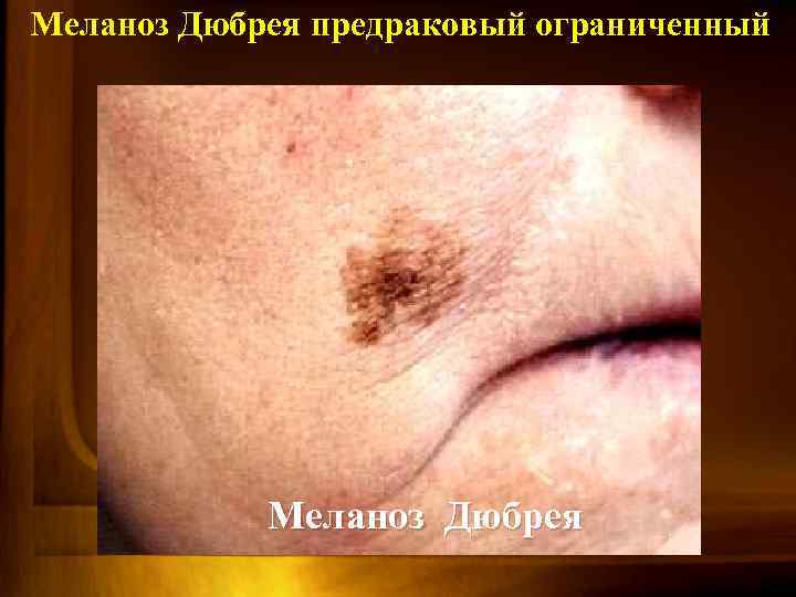 Меланоз Дюбрея предраковый ограниченный Меланоз Дюбрея 