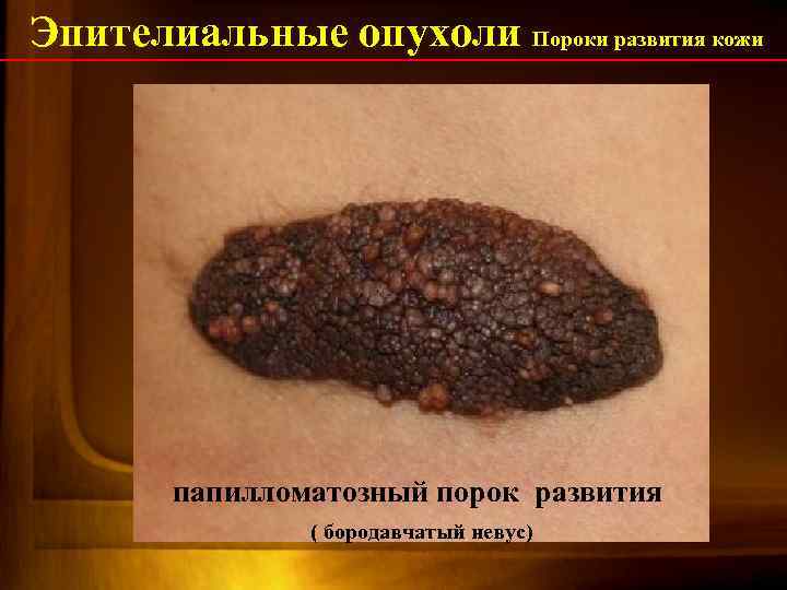 Эпителиальные опухоли Пороки развития кожи папилломатозный порок развития ( бородавчатый невус) 