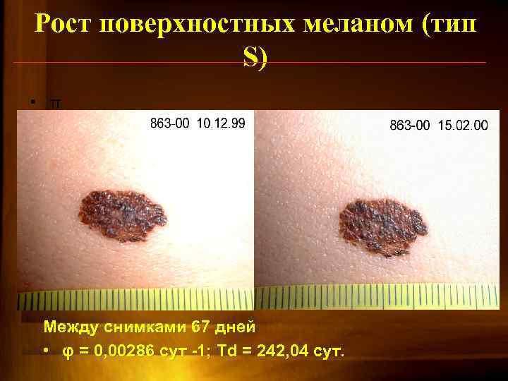 Рост поверхностных меланом (тип S) • π Между снимками 67 дней • φ =