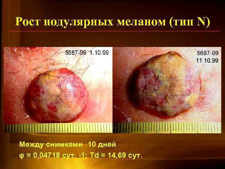 Рост нодулярных меланом (тип N) Между снимками 10 дней φ = 0, 04718 сут.