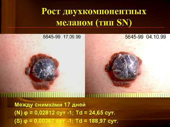 Рост двухкомпонентных меланом (тип SN) Между снимками 17 дней (N) φ = 0, 02812