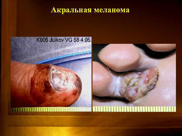 Акральная меланома 