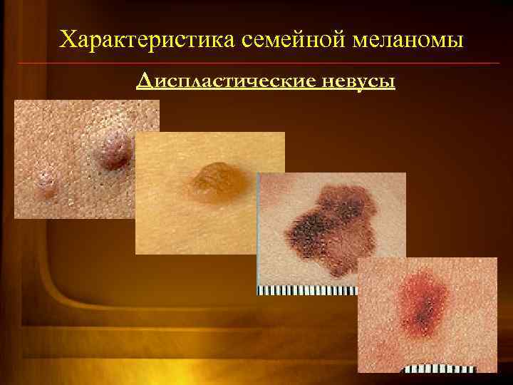 Характеристика семейной меланомы Диспластические невусы 