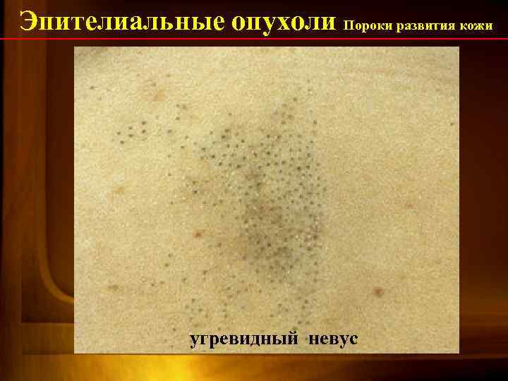 Эпителиальные опухоли Пороки развития кожи папилломатозный порок развития угревидный невус ( бородавчатый невус) 