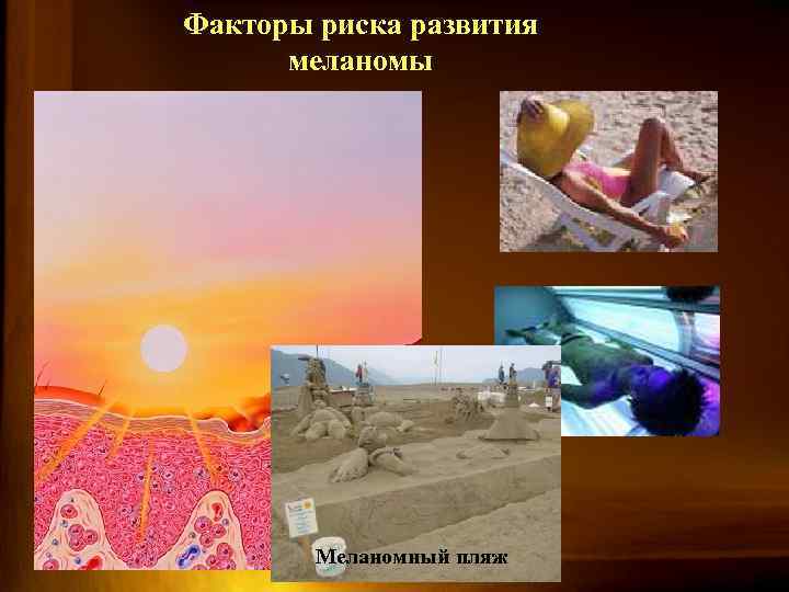 Факторы риска развития меланомы Меланомный пляж 