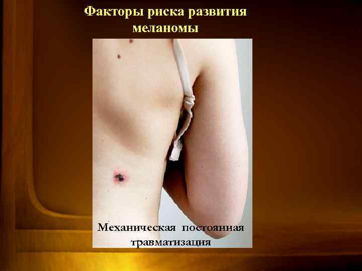Факторы риска развития меланомы Механическая постоянная травматизация 