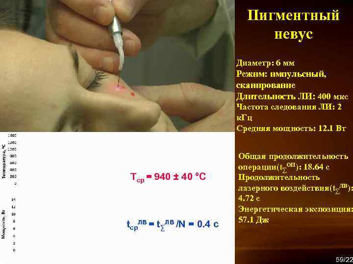Пигментный невус Диаметр: 6 мм Режим: импульсный, сканирование Длительность ЛИ: 400 мкс Частота следования