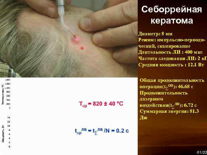 Себоррейная кератома Диаметр: 8 мм Режим: импульсно-периодический, сканирование Длительность ЛИ : 400 мкс Частота