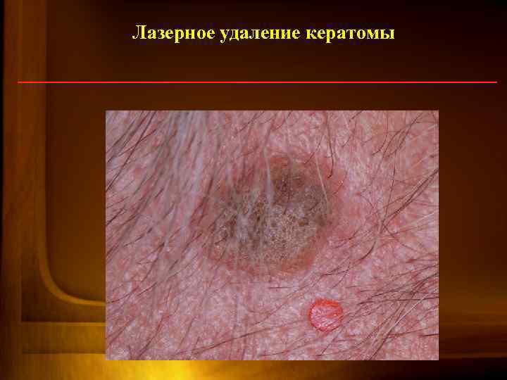 Лазерное удаление кератомы 