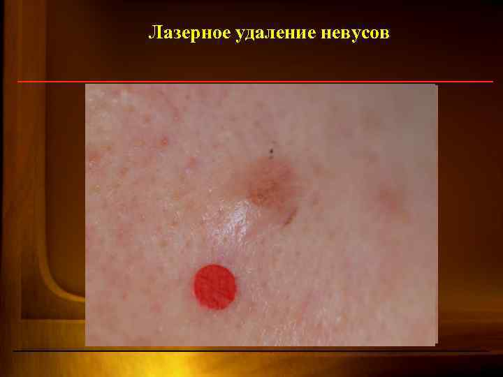 Лазерное удаление невусов 