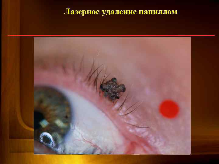 Лазерное удаление папиллом 