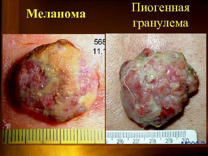 Меланома Пиогенная гранулема 