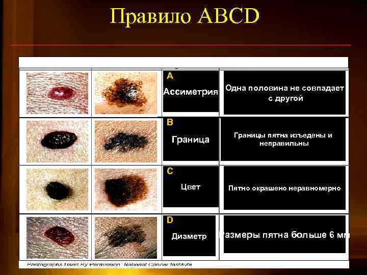 Правило ABCD Нормальный невус Меланома Признак Характеристика A Ассиметрия Одна половина не совпадает с
