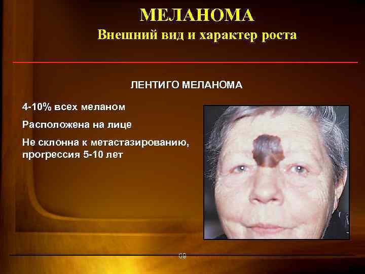МЕЛАНОМА Внешний вид и характер роста ЛЕНТИГО МЕЛАНОМА 4 -10% всех меланом Расположена на