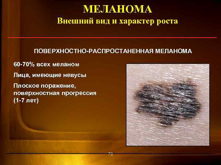 МЕЛАНОМА Внешний вид и характер роста ПОВЕРХНОСТНО-РАСПРОСТАНЕННАЯ МЕЛАНОМА 60 -70% всех меланом Лица, имеющие