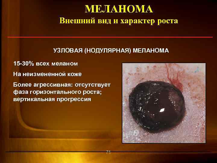 МЕЛАНОМА Внешний вид и характер роста УЗЛОВАЯ (НОДУЛЯРНАЯ) МЕЛАНОМА 15 -30% всех меланом На