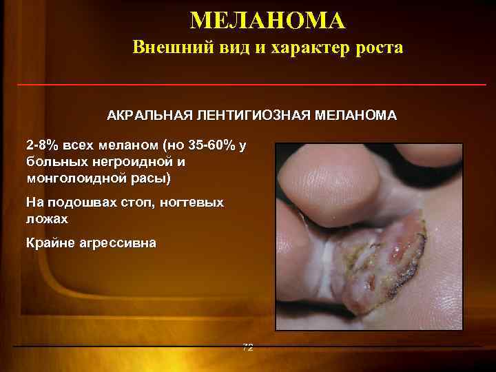 МЕЛАНОМА Внешний вид и характер роста АКРАЛЬНАЯ ЛЕНТИГИОЗНАЯ МЕЛАНОМА 2 -8% всех меланом (но