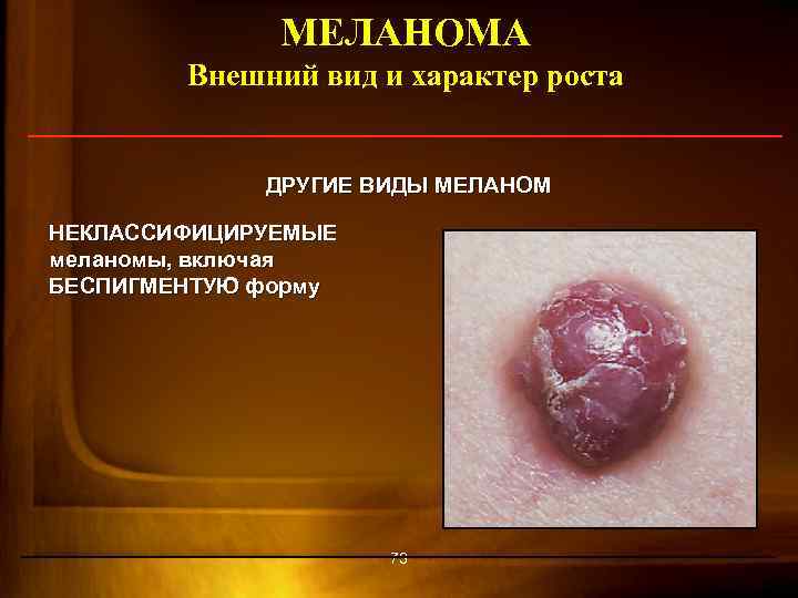 МЕЛАНОМА Внешний вид и характер роста ДРУГИЕ ВИДЫ МЕЛАНОМ НЕКЛАССИФИЦИРУЕМЫЕ меланомы, включая БЕСПИГМЕНТУЮ форму