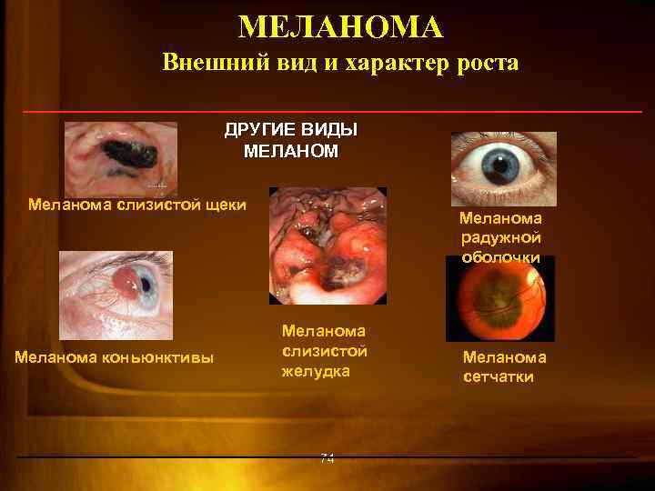 МЕЛАНОМА Внешний вид и характер роста ДРУГИЕ ВИДЫ МЕЛАНОМ Меланома слизистой щеки Меланома коньюнктивы